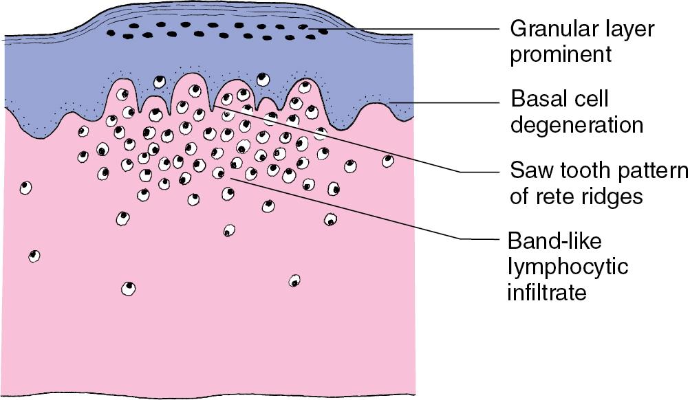 Fig. 23.1, Histopathology of lichen planus.