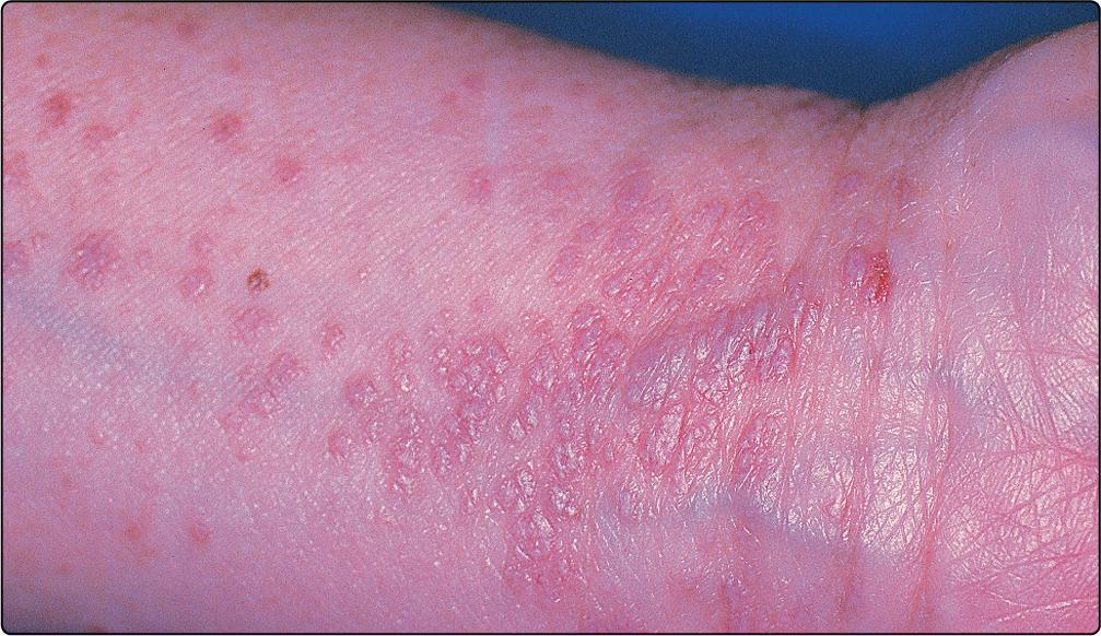 Fig. 23.2, Typical violaceous papules of lichen planus at the wrist.