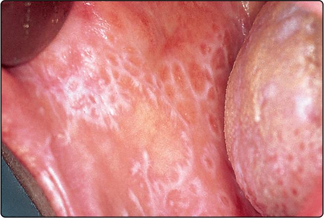 Fig. 23.3, White lace-like Wickham’s striae on the buccal mucosa.