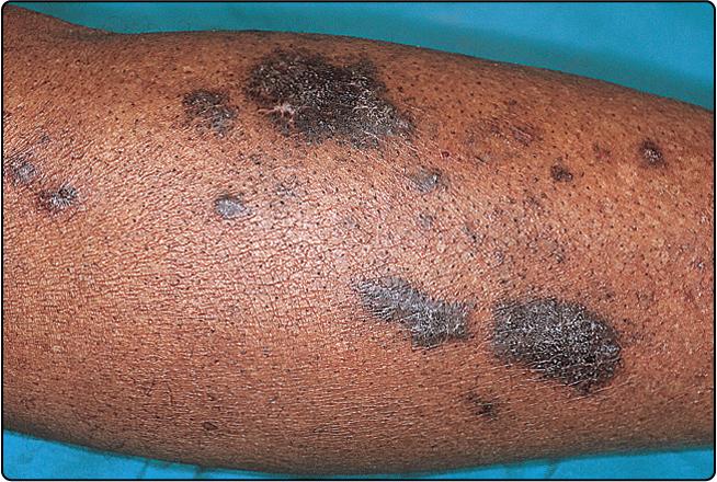 Fig. 23.4, Hypertrophic lichen planus showing hyperpigmentation.