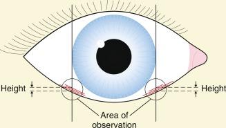 Fig. 12.2, Area of the eye (circles) where LIPCOFs should be observed and graded.