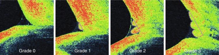 Fig. 12.5, LIPCOF grading using anterior segment optical coherence tomography. The number of folds (outlined) can be clearly seen, with one, two and three folds evident in grades 1, 2 and 3, respectively.