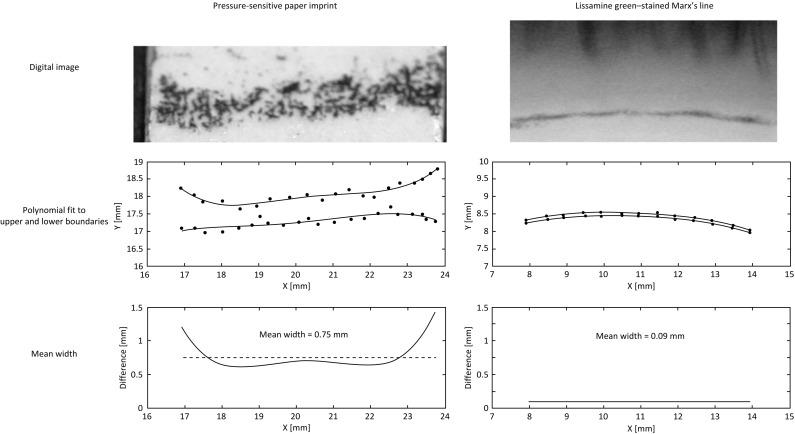 Fig. 5.2, Examples of the digital images (top) and analysis (middle and lower) from one subject of a contact imprint of the lid wiper (mean width 0.75 mm) and lissamine green staining of the line of Marx (mean width 0.09 mm). Both widths were averaged over approximately the central 6 mm of the eyelids.