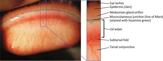 Fig. 5.4, Normal everted eyelid, showing the location of the lid wiper and adjacent anatomical structures. Lissamine green stain highlights the mucocutaneous junction (line of Marx).