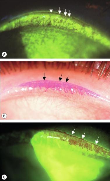 Fig. 5.5, (A) The everted upper eyelid with moderate lid wiper epitheliopathy (LWE) shown by fluorescein staining. The lid wiper was photographed with black light after two instillations of fluorescein dye and a single instillation of rose bengal dye. Rose bengal did not stain this lid wiper. (B) The everted upper eyelid with moderate LWE shown by rose bengal staining. The lid wiper was photographed with white light illumination after two instillations of fluorescein dye and a single instillation of rose bengal dye. Because fluorescein did not stain this lid wiper, the ocular surfaces were irrigated with normal saline to remove the fluorescein and enhance the photograph. (C) The everted upper eyelid with severe LWE shown by fluorescein and rose bengal staining. The lid wiper was photographed with black light illumination after two instillations of fluorescein dye and a single instillation of rose bengal dye, but without irrigation of the ocular surfaces.