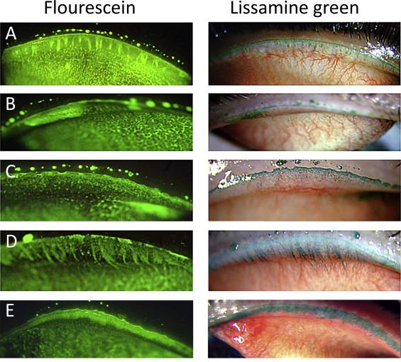 Fig. 5.6, Various appearances of lid wiper epitheliopathy (LWE) revealed by fluorescein (left column) and lissamine green (right column) : (A) vertical streaks, (B) short horizontal band, (C) speckled appearance, (D) comb appearance, (E) broad horizontal band.