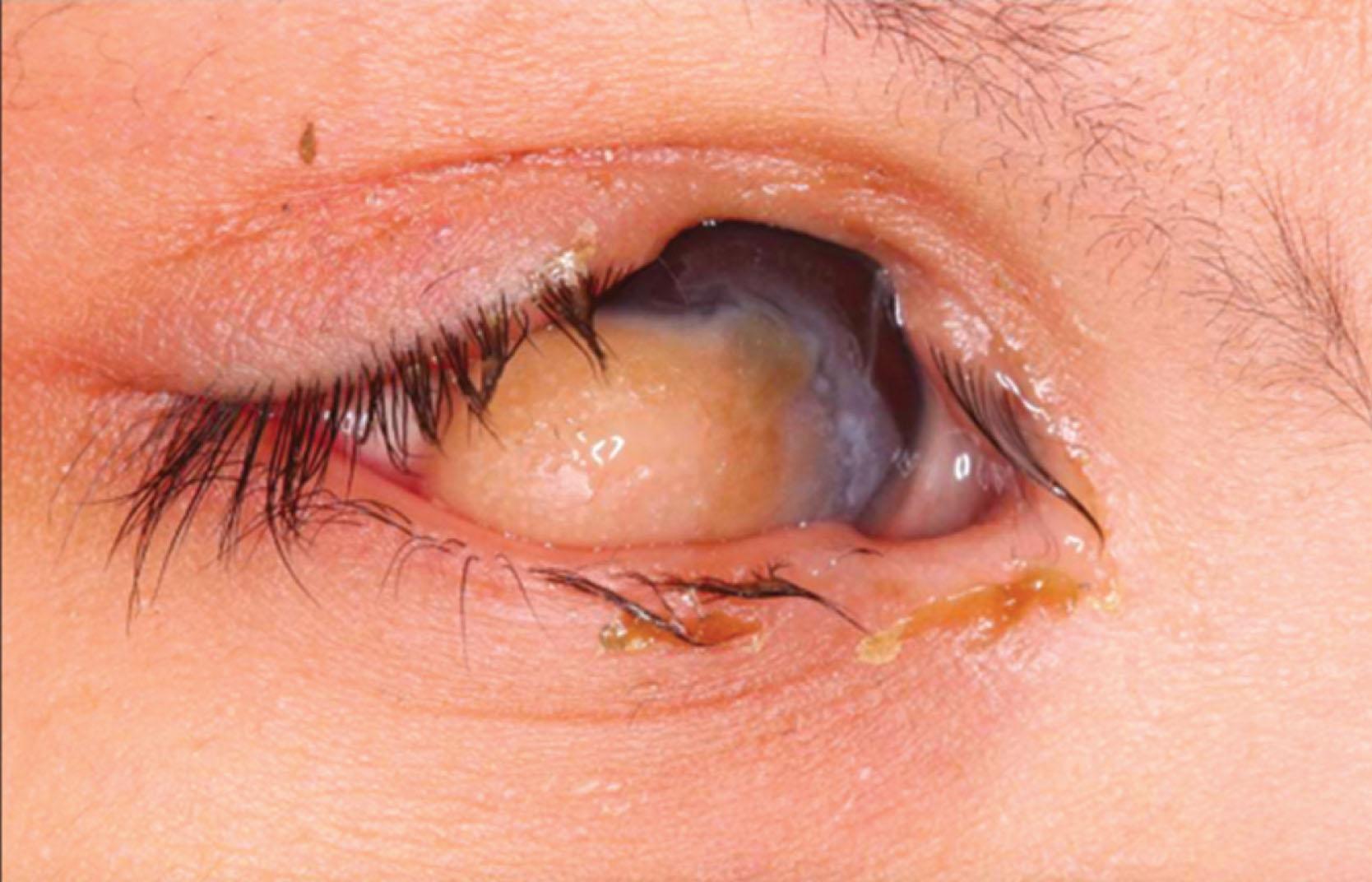 Fig. 17.1, Right eye of child with Goldenhar syndrome; there is an upper lid coloboma and a large limbal dermoid.