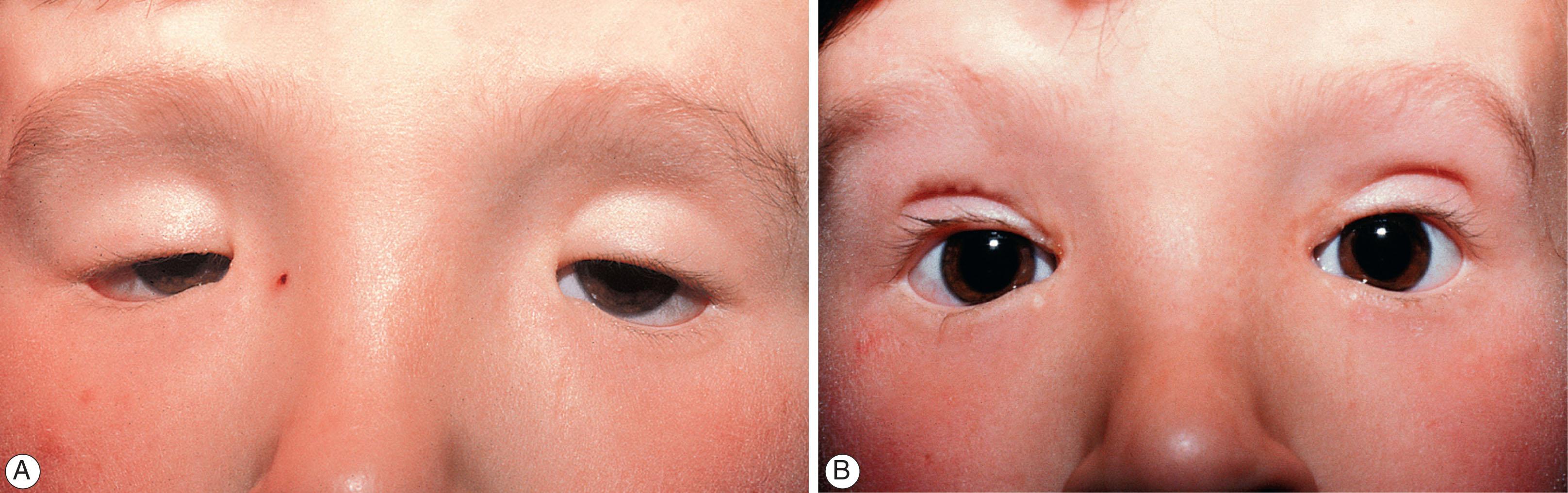 Fig. 17.11, Blepharophimosis. (A) This patient has blepharophimosis syndrome with blepharophimosis, ptosis, and telecanthus. (B) The same child after Y–V canthoplasties followed by brow suspensions with autogenous fascia lata.