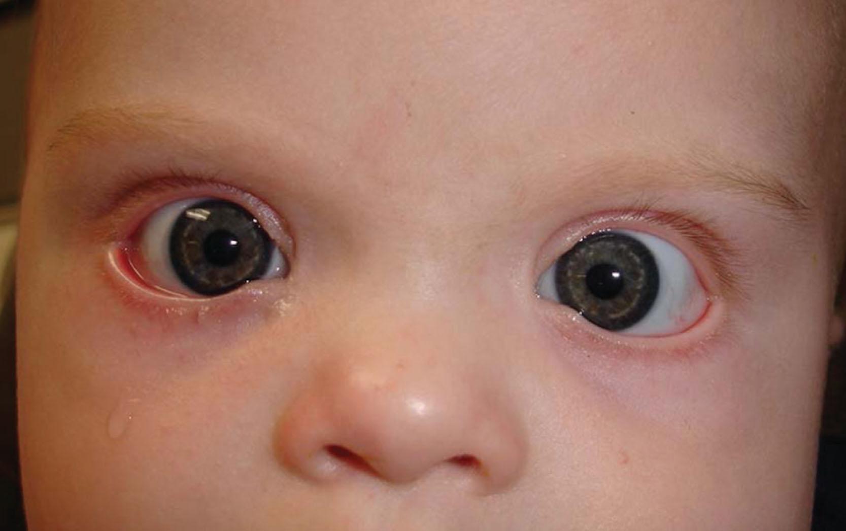 Fig. 17.4, This infant with trisomy 21 has bilateral lower lid ectropion and euryblepharon.