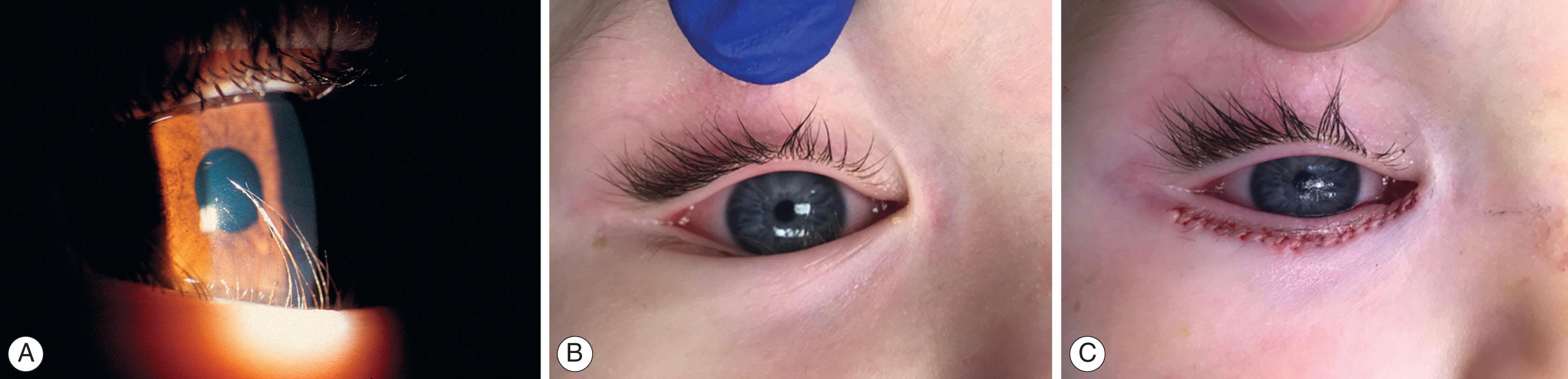 Fig. 17.5, Epiblepharon. (A) A fold of pretarsal orbicularis and eyelid skin override the lower lid margin resulting in posterior ciliary rotation and eyelash–cornea touch. (B) This child had lash–cornea touch preoperatively associated with photophobia and foreign body sensation. (C) Lash–cornea touch resolved status post Celsus procedure for correction of epiblepharon.