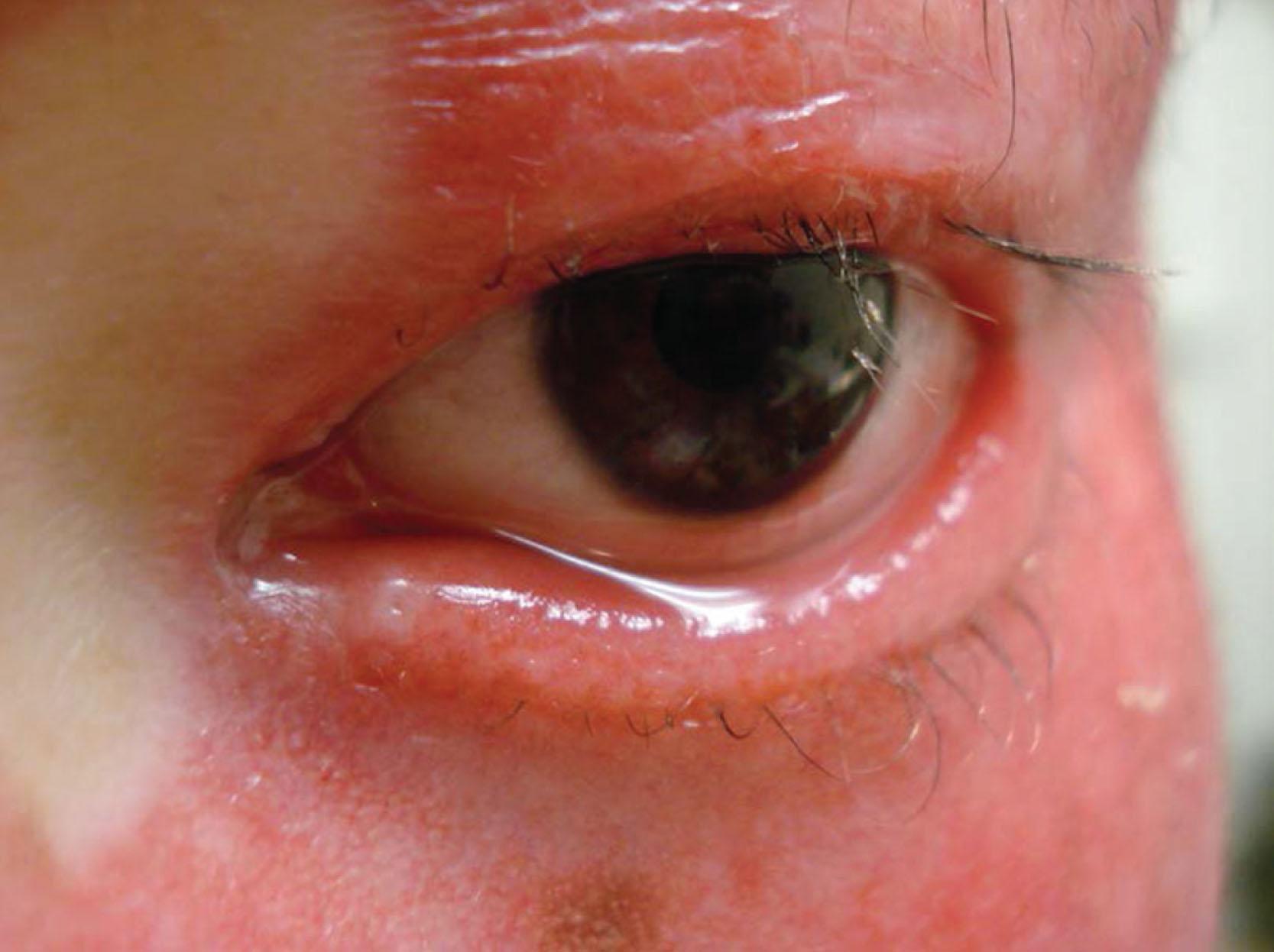 Fig. 17.6, This 6-year-old with ichthiosis has anterior lamellar shortening which has resulted in lower lid ectropion.