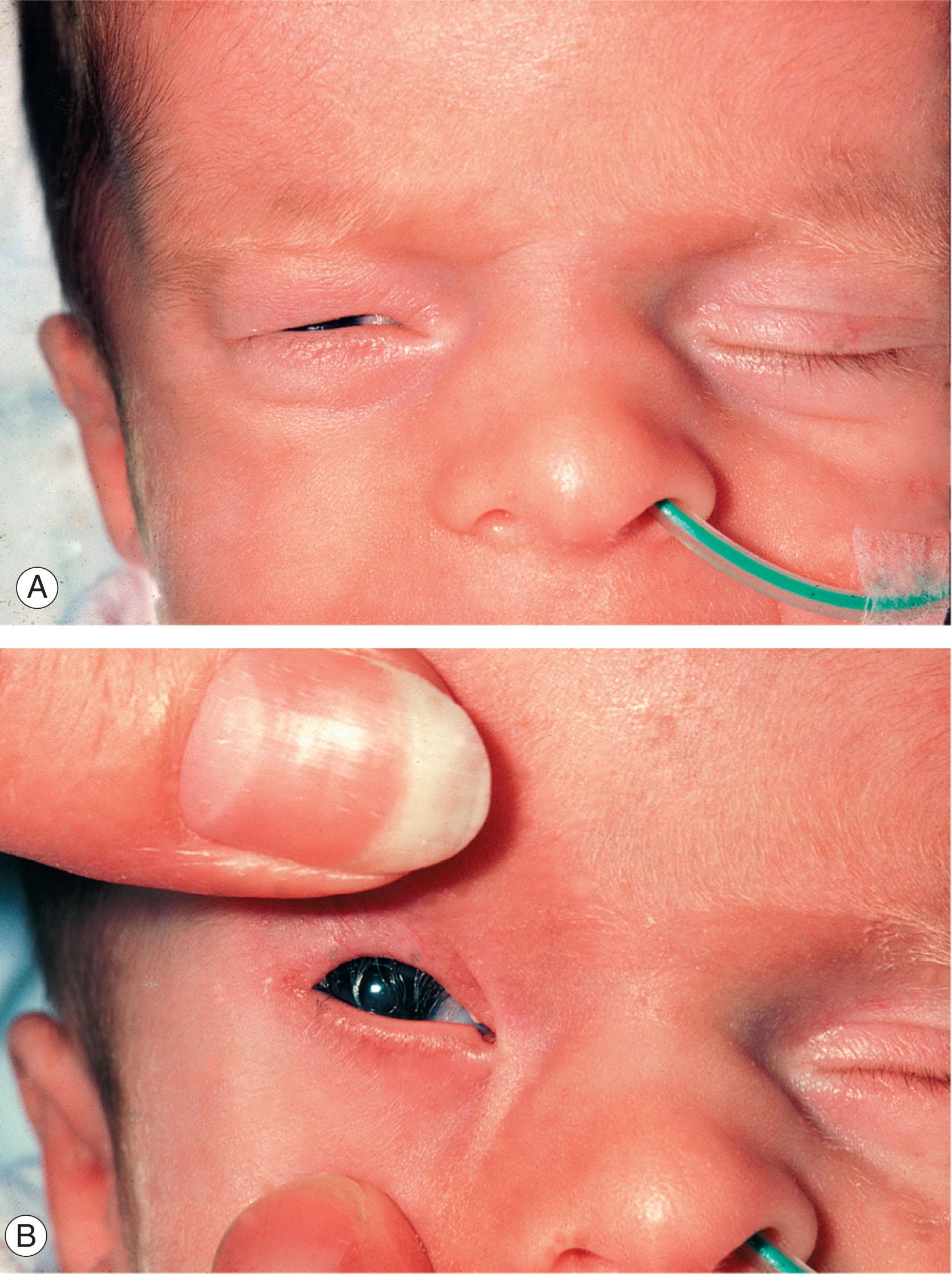 Fig. 17.7, Congenital entropion. (A) This child presented with irritability and inward turning of the right upper eyelid, which was slightly swollen. (B) The same child with the lid partially everted, showing the lashes inturned and contacting the cornea. This was treated with simple lid suture and resolved without complication.