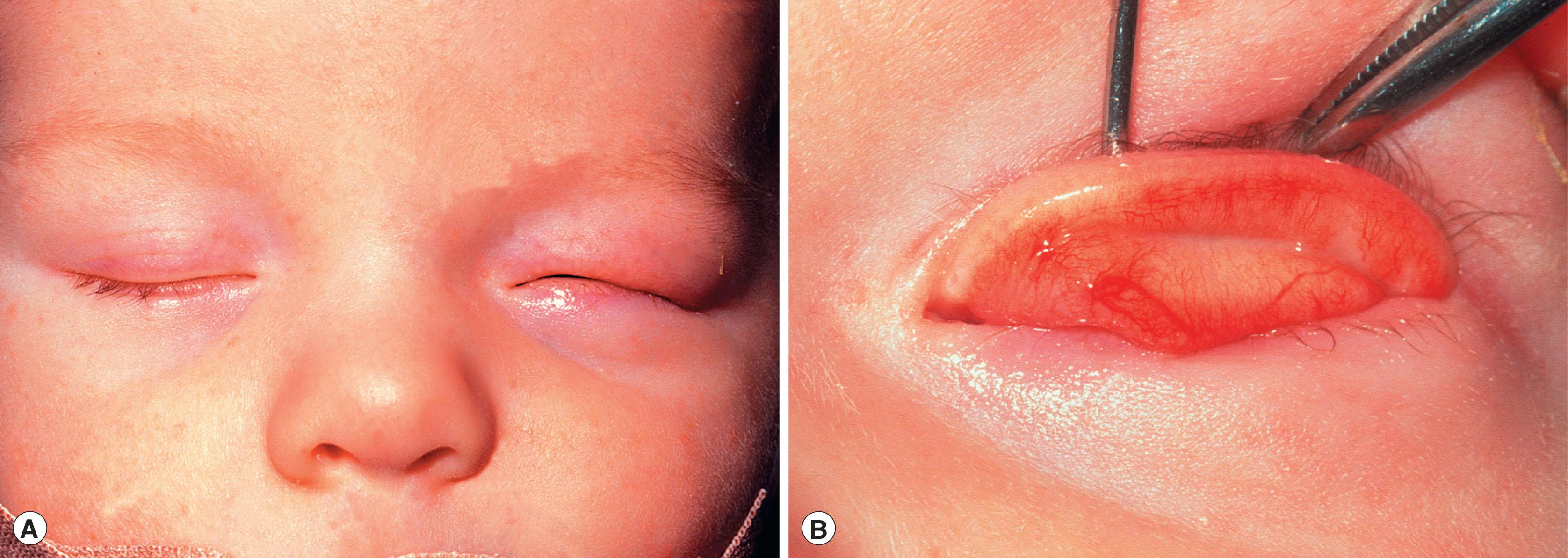 Fig. 17.8, Horizontal tarsal kink. (A) This child presented with a swollen and sore left eye with blepharospasm. (B) On eversion of the left upper lid, the horizontal kink in the tarsus can be seen. It runs the whole length of the tarsal plate, which is bent to 90°. It was treated by lid suture, and the condition resolved but there was severe corneal scarring.