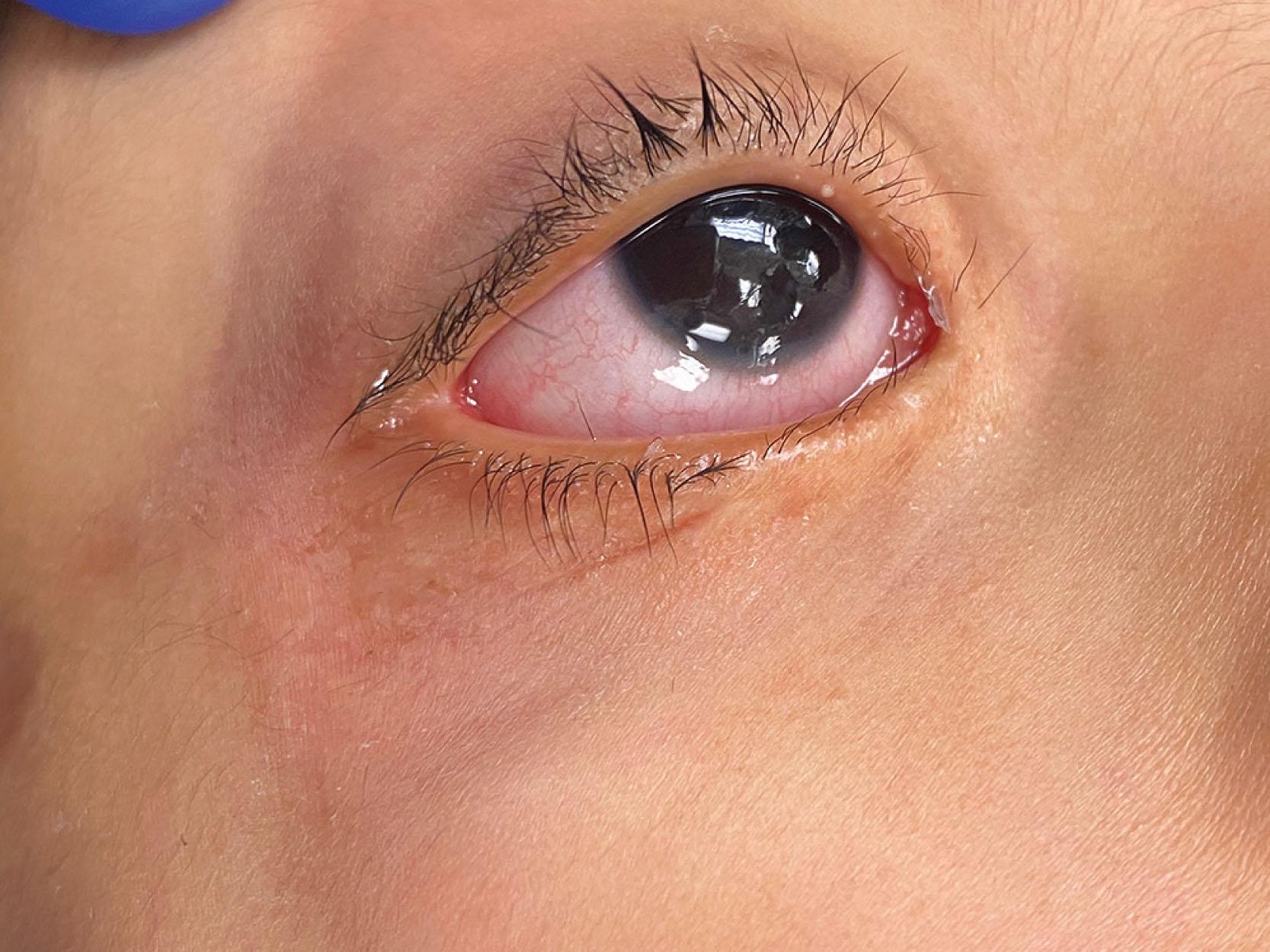 Fig. 17.9, Lower eyelid distichiasis with two eyelashes protruding from meibomian gland orifices. Note that the patient has already undergone a medial Celsus procedure for epiblepharon, but requires additional correction.