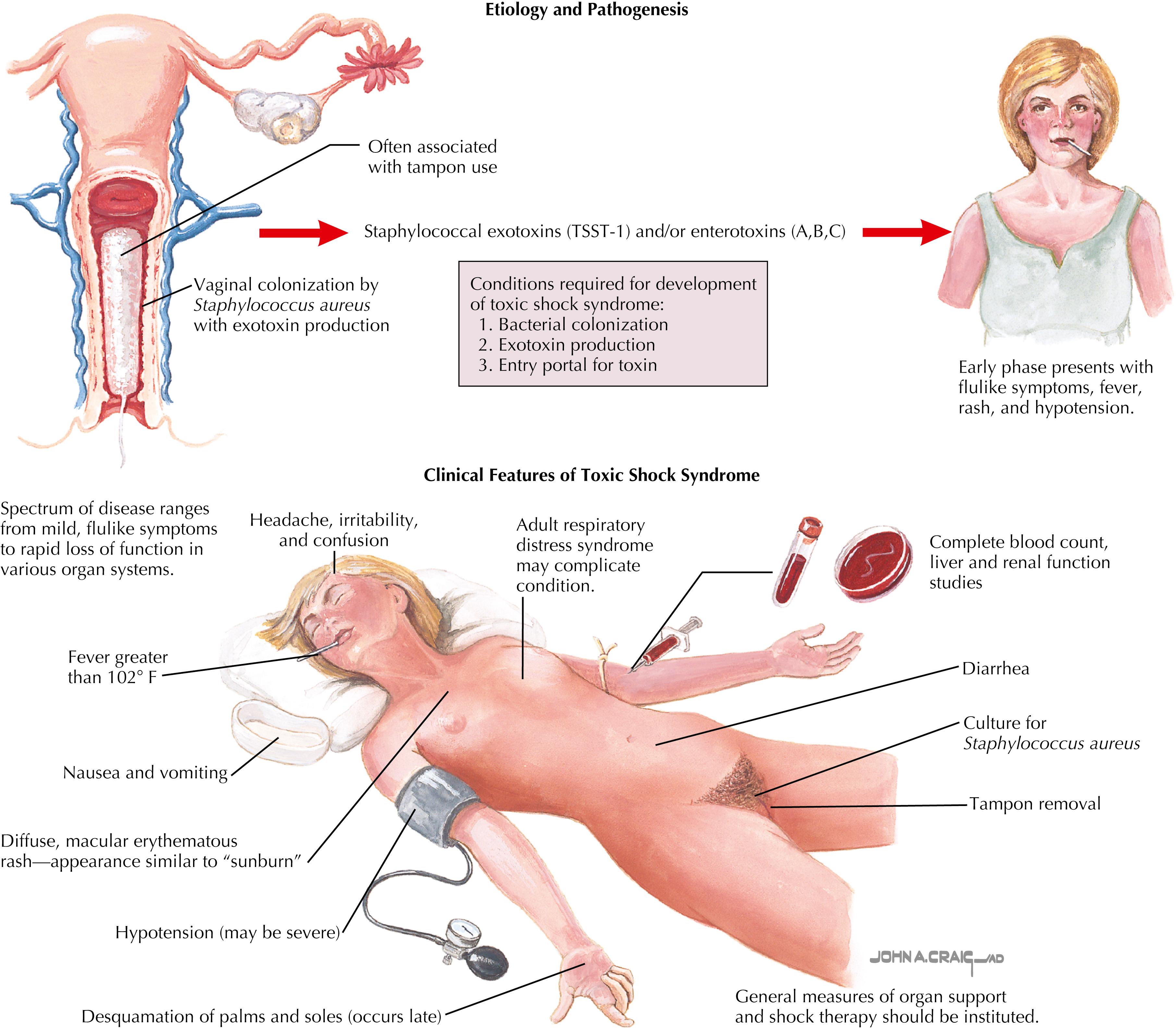 Fig. 21.1, Staphylococcal toxic shock syndrome.