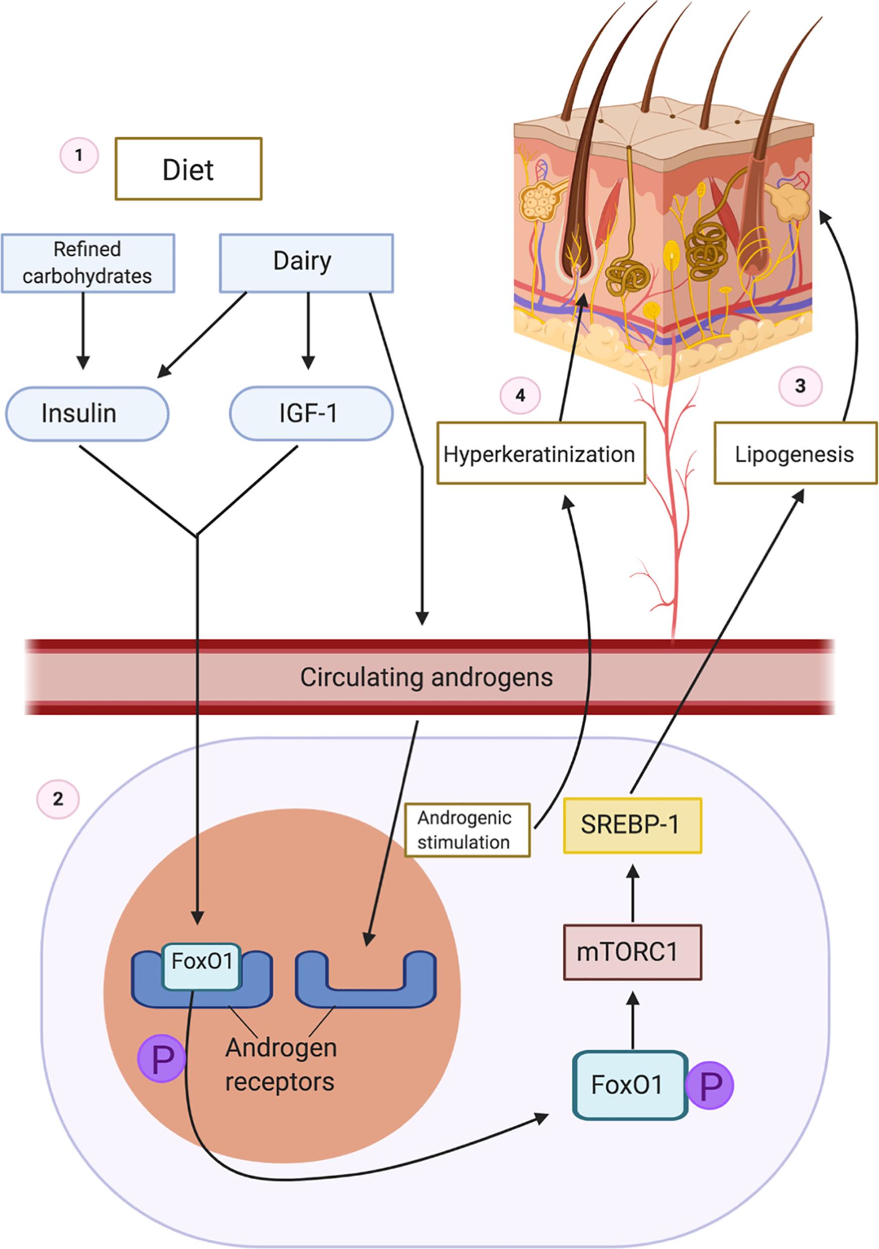 Fig. 27.1, Hypothesized Mechanism of Dietary Exacerbation of Hidradenitis Suppurativa. 1. Ingestion of carbohydrates increases insulin. Dairy increases insulin, IGF-1, and circulating androgens. 2. FoxO1 is normally bound to the androgen receptor to suppress androgenic signaling. Increased insulin and IGF-1 levels lead to phosphorylation of nuclear FoxO1, which causes subsequent expulsion of FoxO1 from the nucleus to the cytoplasm. 3. In the cytoplasm, FoxO1 stimulates mTORC, which acts on STEBP to increase lipogenesis. 4. Circulating endogenous and exogenous androgens bind to androgen receptors, leading to hyperkeratinization of the hair follicle which eventually ruptures.