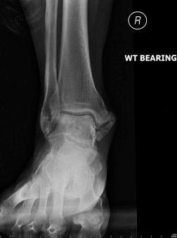 Fig. 117.11, Radiograph showing a chronic heterotopic ossification after a deltoid ligament avulsion injury.