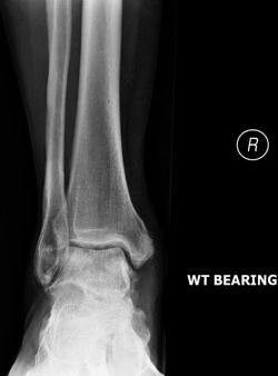 Fig. 117.12, Postoperative radiograph 6 weeks after débridement of heterotopic ossification and reattachment of the deltoid ligament.