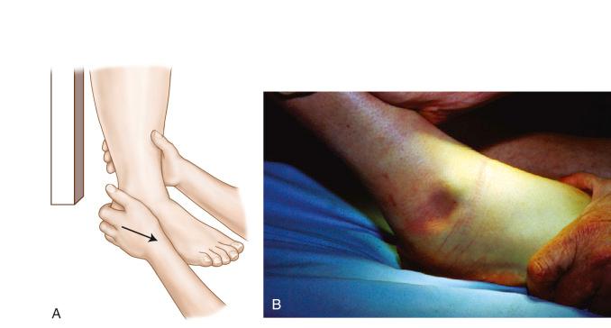 Fig. 117.2, (A and B) The anterior drawer test of the ankle. Note the skin dimple consistent with a positive test.