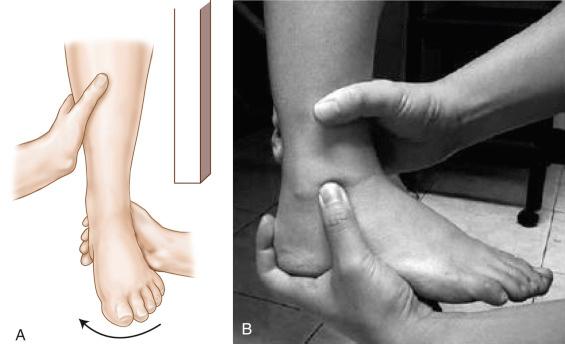 Fig. 117.3, (A and B) The talar tilt (inversion stress) test of the ankle.