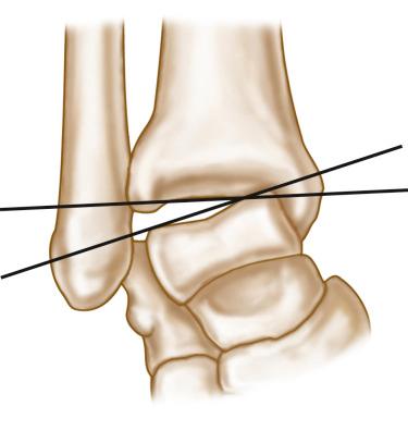 Fig. 117.4, The talar tilt (inversion) as it would be seen on a stress radiograph. The talar tilt angle refers to the angle between two lines drawn to the tibial plafond and the talar dome.