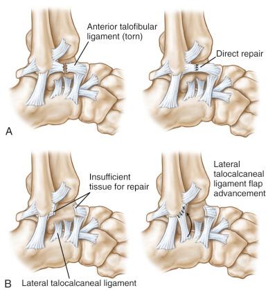 Fig. 117.5, The repair of a chronic lateral ankle ligament rupture as described by Broström. (A) A chronic anterior talofibular ligament rupture and direct repair. (B) A chronic anterior talofibular ligament rupture with insufficient tissue for simple direct repair and reconstruction with advancement of the flap of the lateral talocalcaneal ligament into the fibula.