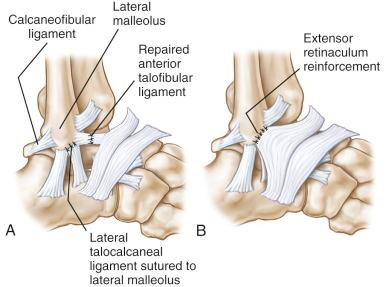 Fig. 117.6, Gould modification of the Broström technique. After repair of the anterior talofibular or calcaneofibular ligament, reinforcements with the lateral talocalcaneal ligament (A) and extensor retinaculum (B) are made.