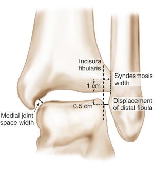 Fig. 117.9, Techniques of measuring the lateral displacement of the lateral malleolus (mortise view) and the width of the syndesmosis (mortise view) and medial joint space (anteroposterior view).