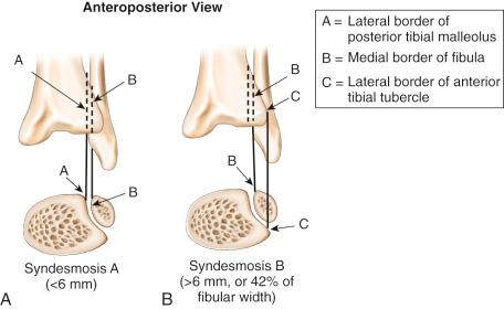 Fig. 117.10, Syndesmotic radiographic criteria. (A) The syndesmosis clear space as depicted on the anteroposterior view and by coronal section. The tibiofibular clear space is the distance between the lateral border of the posterior tibial malleolus (point A ) and the medial border of the fibula (point B ) on the anteroposterior radiograph. This space is normally less than 6 mm. (B) The syndesmosis overlap as seen on the anteroposterior view and by coronal section. The tibiofibular overlap is the distance between the medial border of the fibula (point B ) and the lateral border of the anterior tibial prominence (point C ) on the anteroposterior radiograph. This space is normally greater than 6 mm, or 42% of the fibular width.