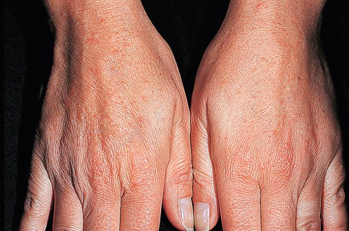 Fig. 15.14, Polymorphous light eruption. The papular type is the most common form. Small papules are densely aggregated. The back of the hands is a common site. The rash itches and is sometimes painful. Lesions persist for 7 to 10 days.