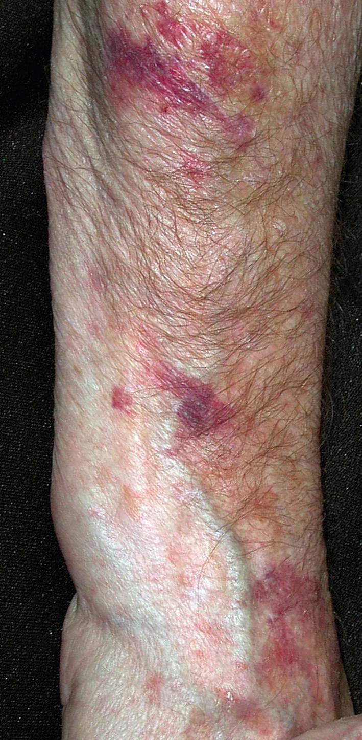 Fig. 15.2, Cutaneous blood vessels are easily damaged by trivial external trauma to sun-damaged skin resulting in asymptomatic but unsightly ecchymosis. Aspirin therapy worsens solar purpura. Regular use of sunscreen and alpha-hydroxy acid moisturizer are of some benefit.