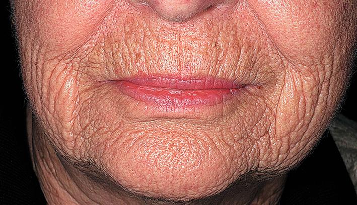 Fig. 15.3, Course wrinkling occurs after loss of elastic tissue and collagen. The skin surface is firm, smooth, and yellow.