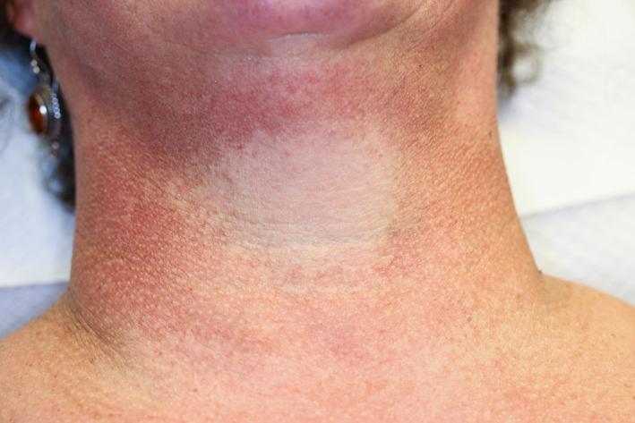 Fig. 15.9, Poikiloderma of Civatte. Chronic sun exposure may cause red-brown pigmentation with telangiectasia and atrophy on the sides of the neck in predisposed individuals. The shaded area under the chin is spared.