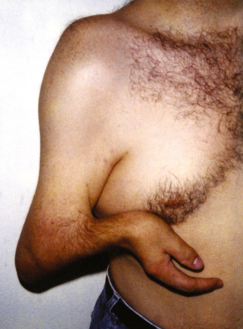 FIGURE 1, Ulnar-mammary syndrome.