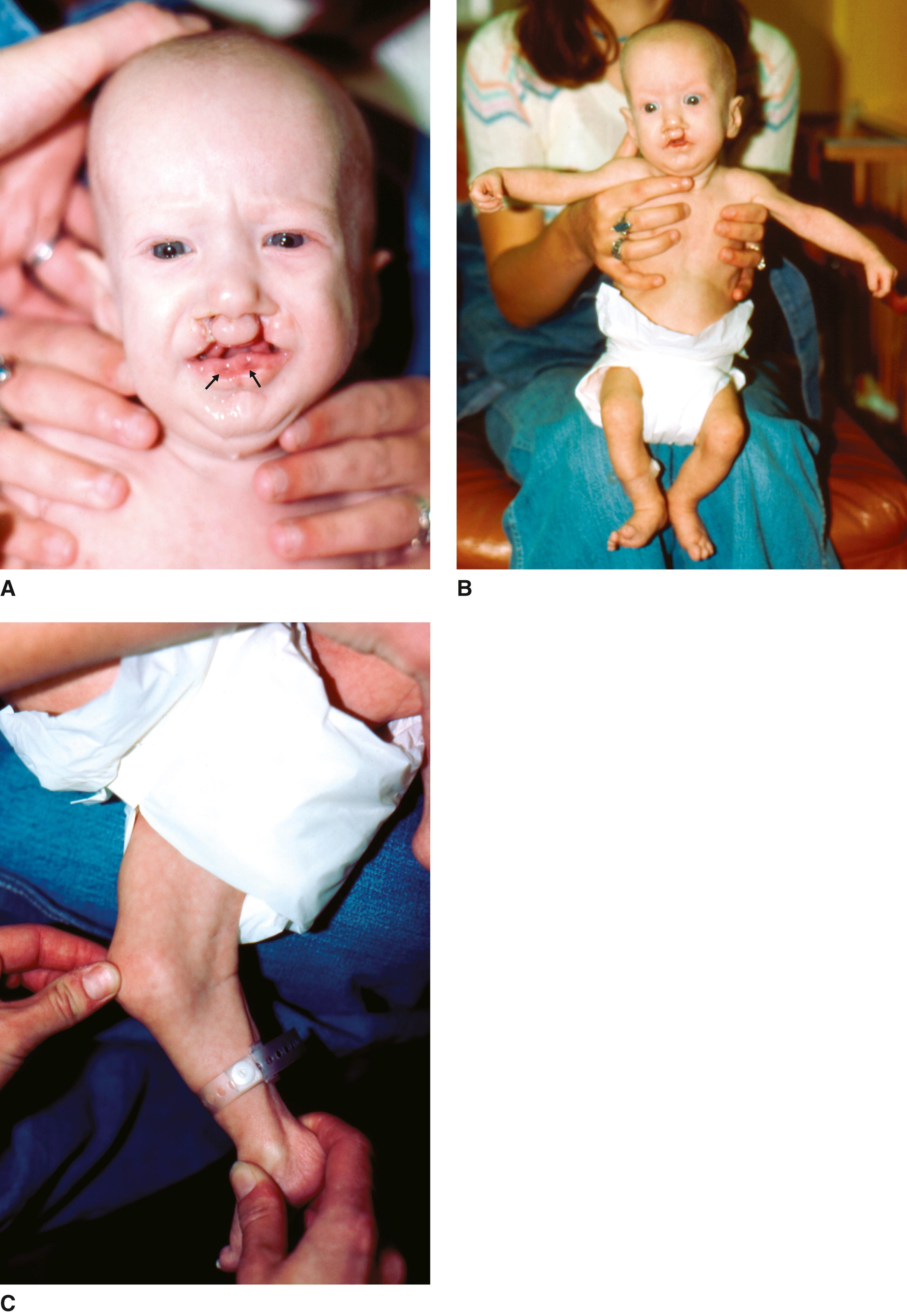 FIGURE 1, Popliteal pterygium syndrome.