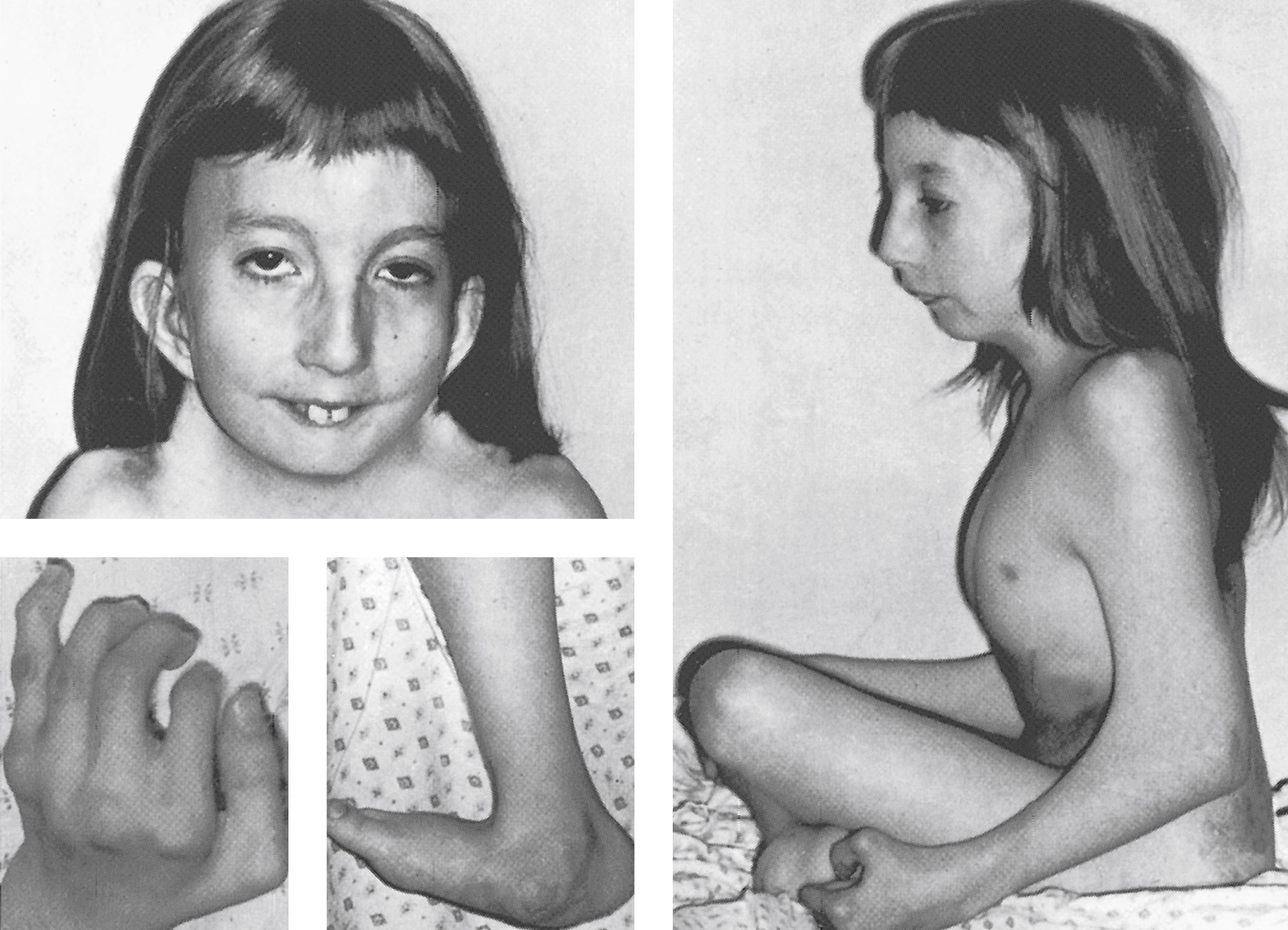 FIGURE 1, A 12-year-old girl showing features of Escobar syndrome.