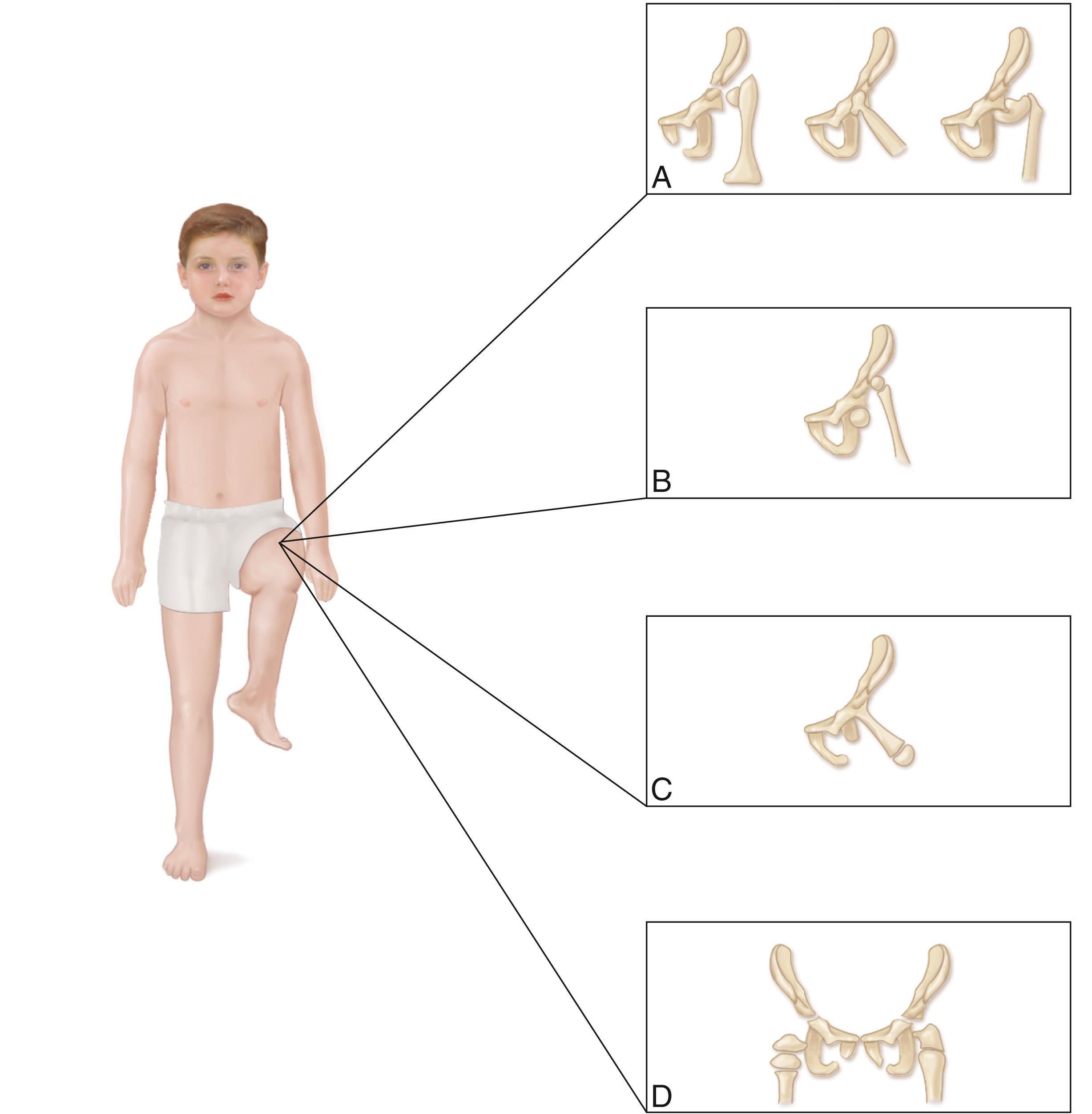 Fig. 21.12, (A–D) Schematic illustration of the Aitken classification of proximal focal femoral deficiency.