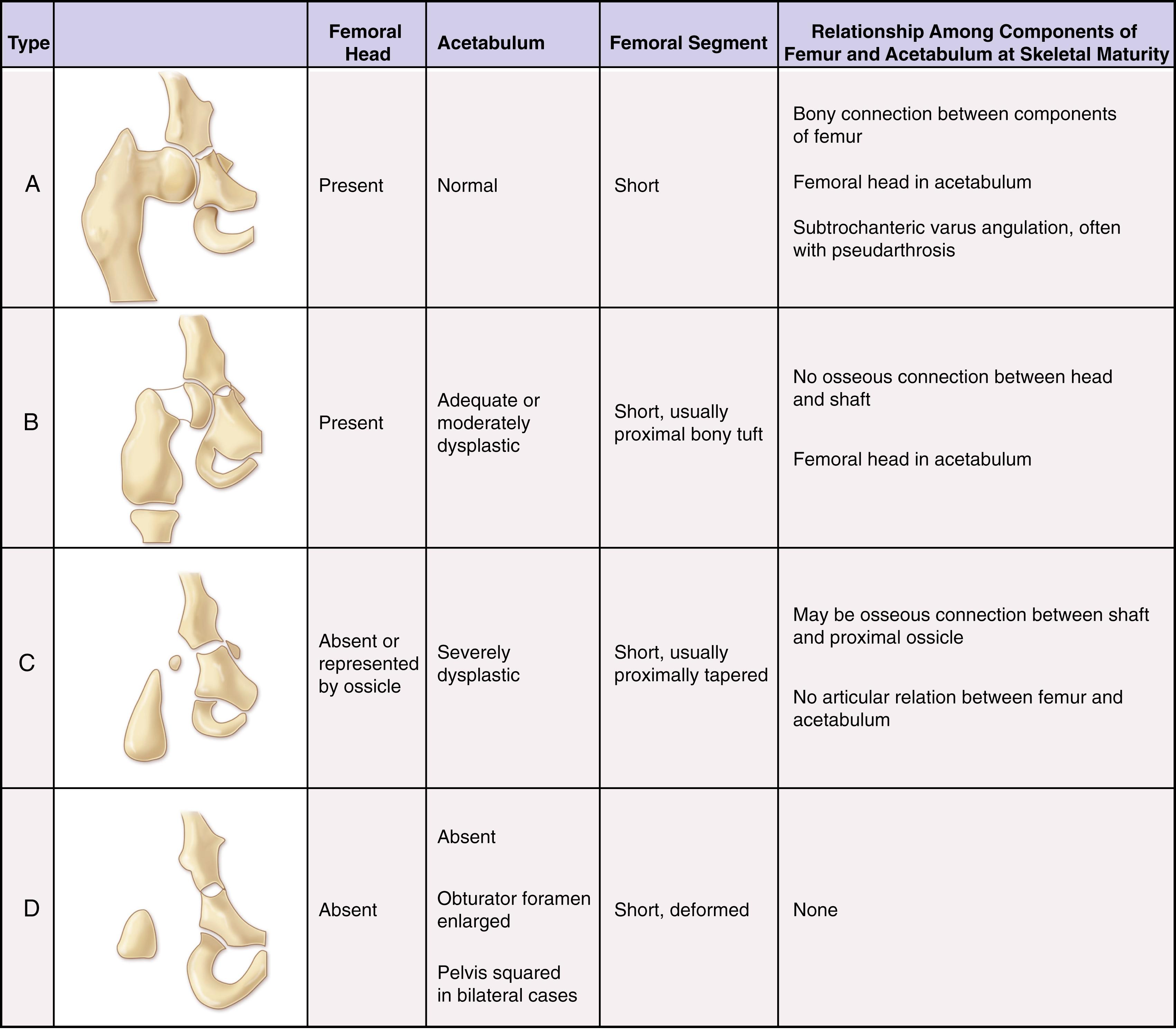 Fig. 21.13, (A–D) Description and illustration of the Aitken classification of proximal focal femoral deficiency.