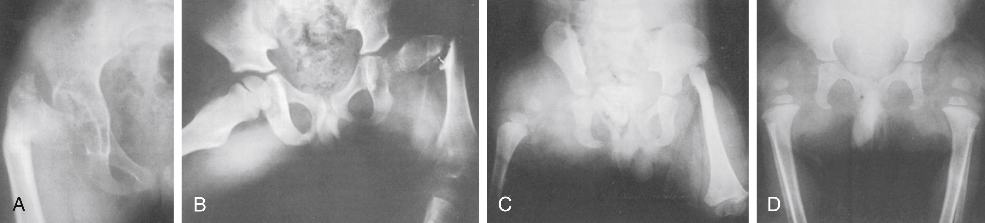 Fig. 21.14, Radiographs showing the four types of proximal focal femoral deficiency according to Aitken. (A) Type A. (B) Type B. (C) Type C. (D) Type D.