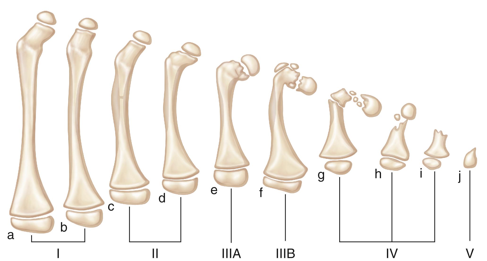 Fig. 21.15, Hamanishi classification of femoral deficiency.