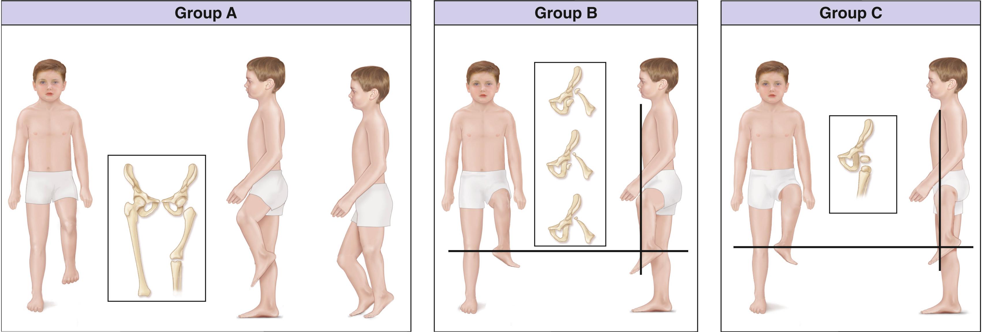 Fig. 21.16, Gillespie classification of femoral deficiency.