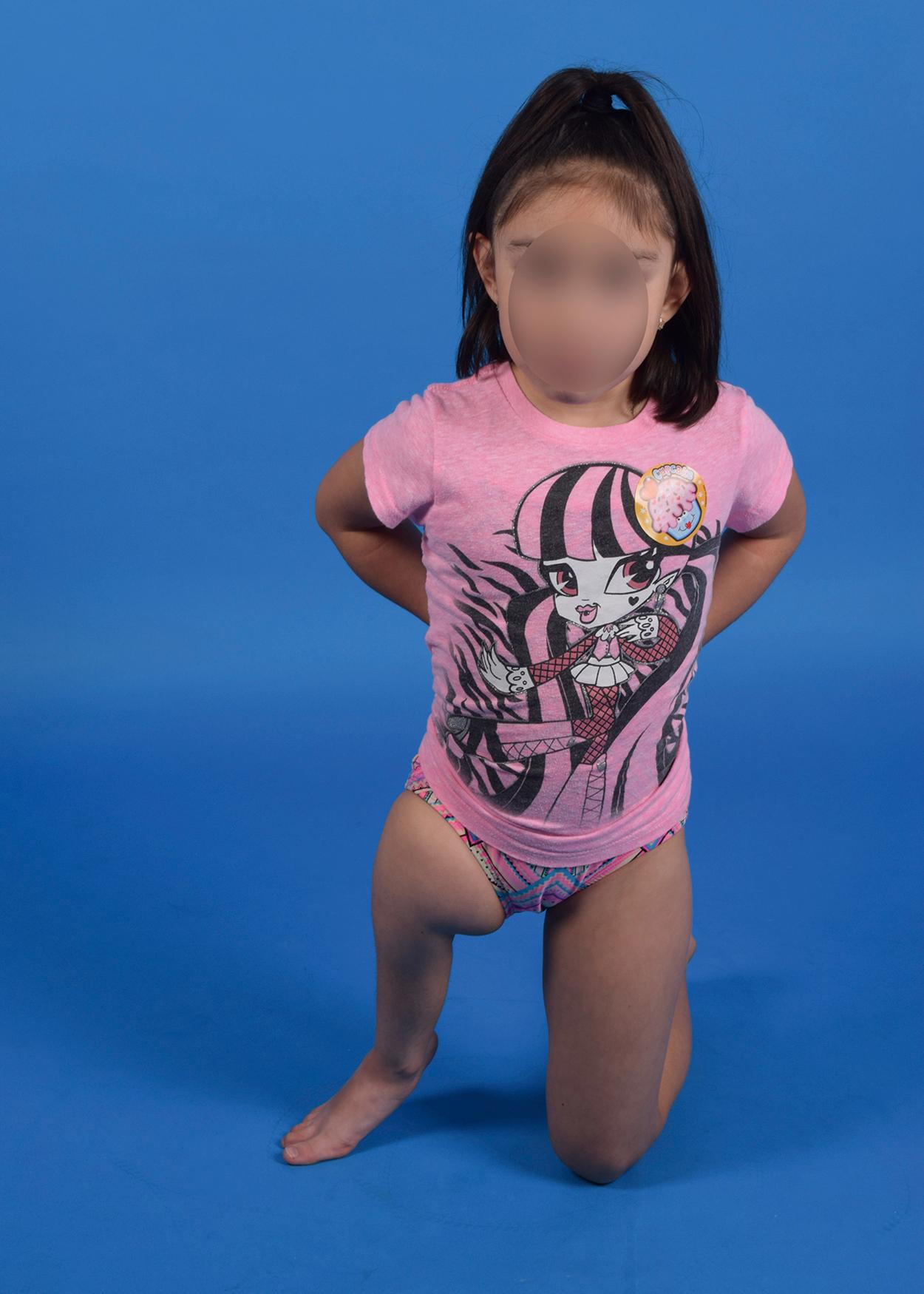 Fig. 21.18, Child with proximal femoral deficiency, who is walking on the knee of the sound side and the foot of the short extremity. She was treated with a Syme amputation, knee fusion, and a prosthesis.