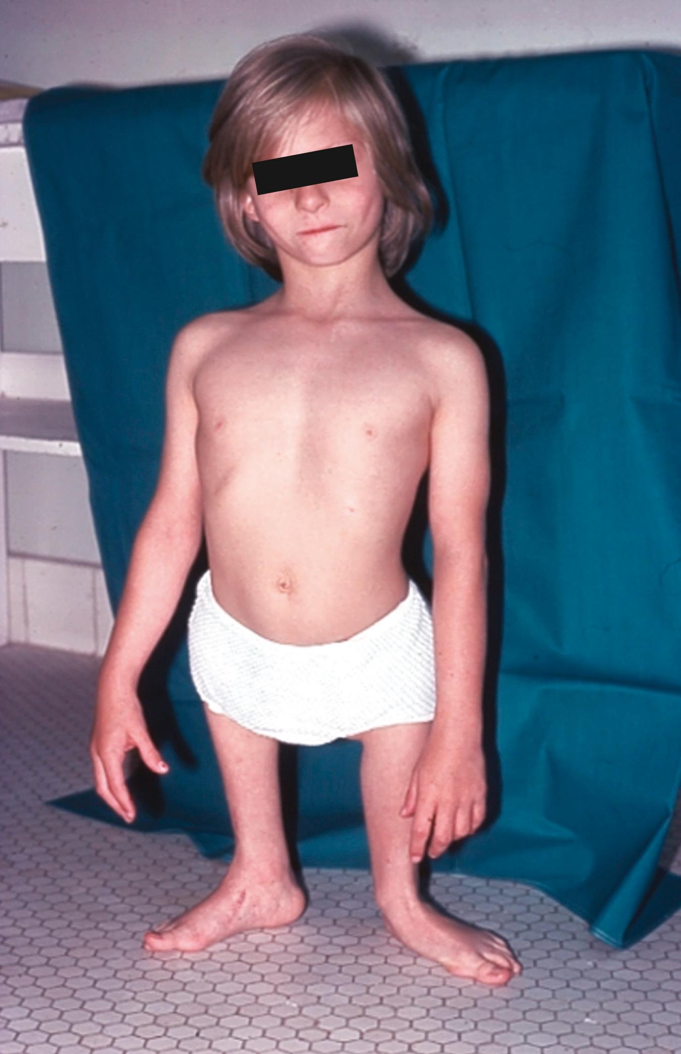 Fig. 21.19, Girl with bilateral femoral deficiency. Prostheses to increase her height are the only appropriate treatment measure.