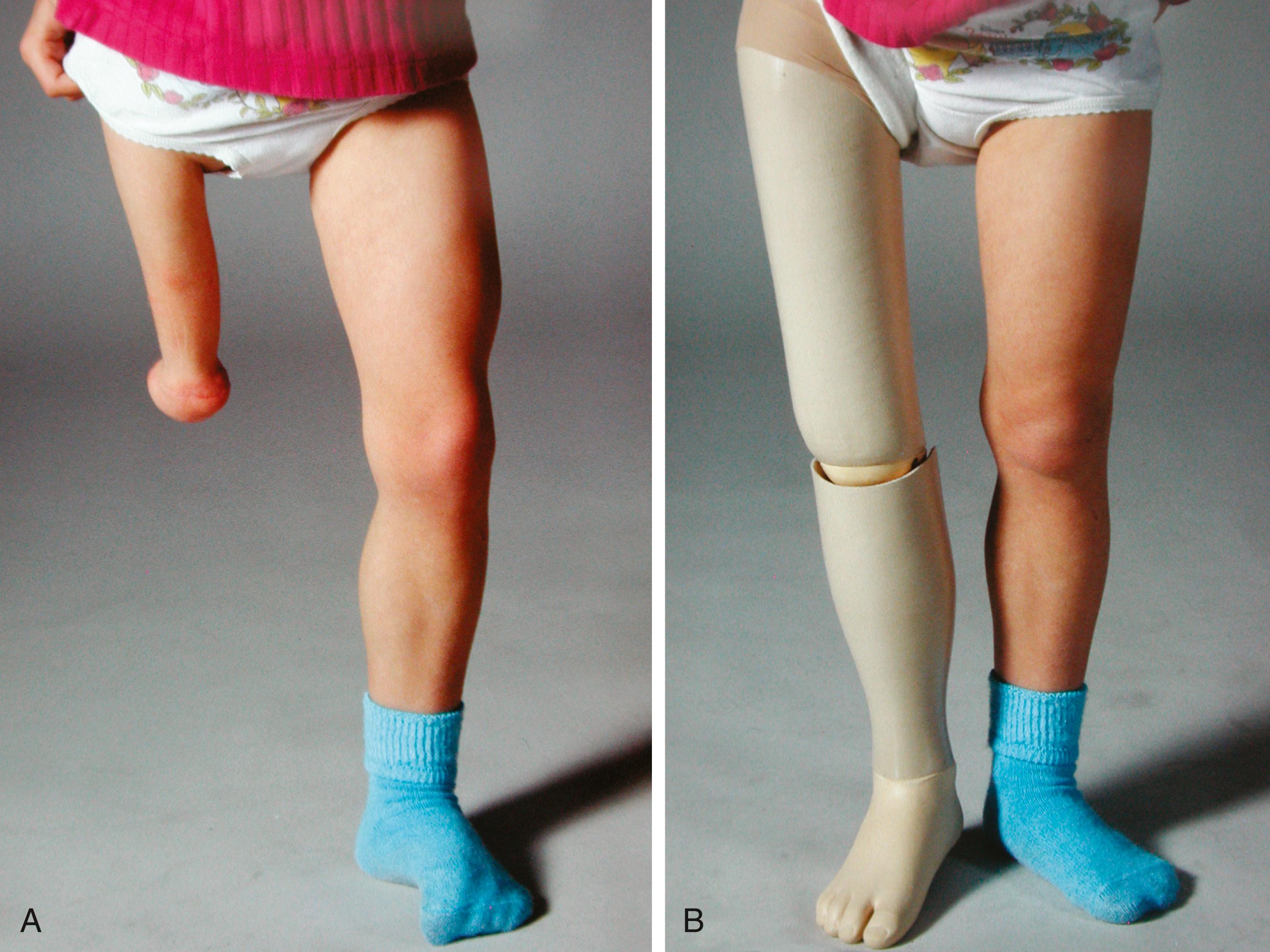 Fig. 21.20, (A and B) Proximal focal femoral deficiency, which was treated with a Syme amputation and knee fusion.