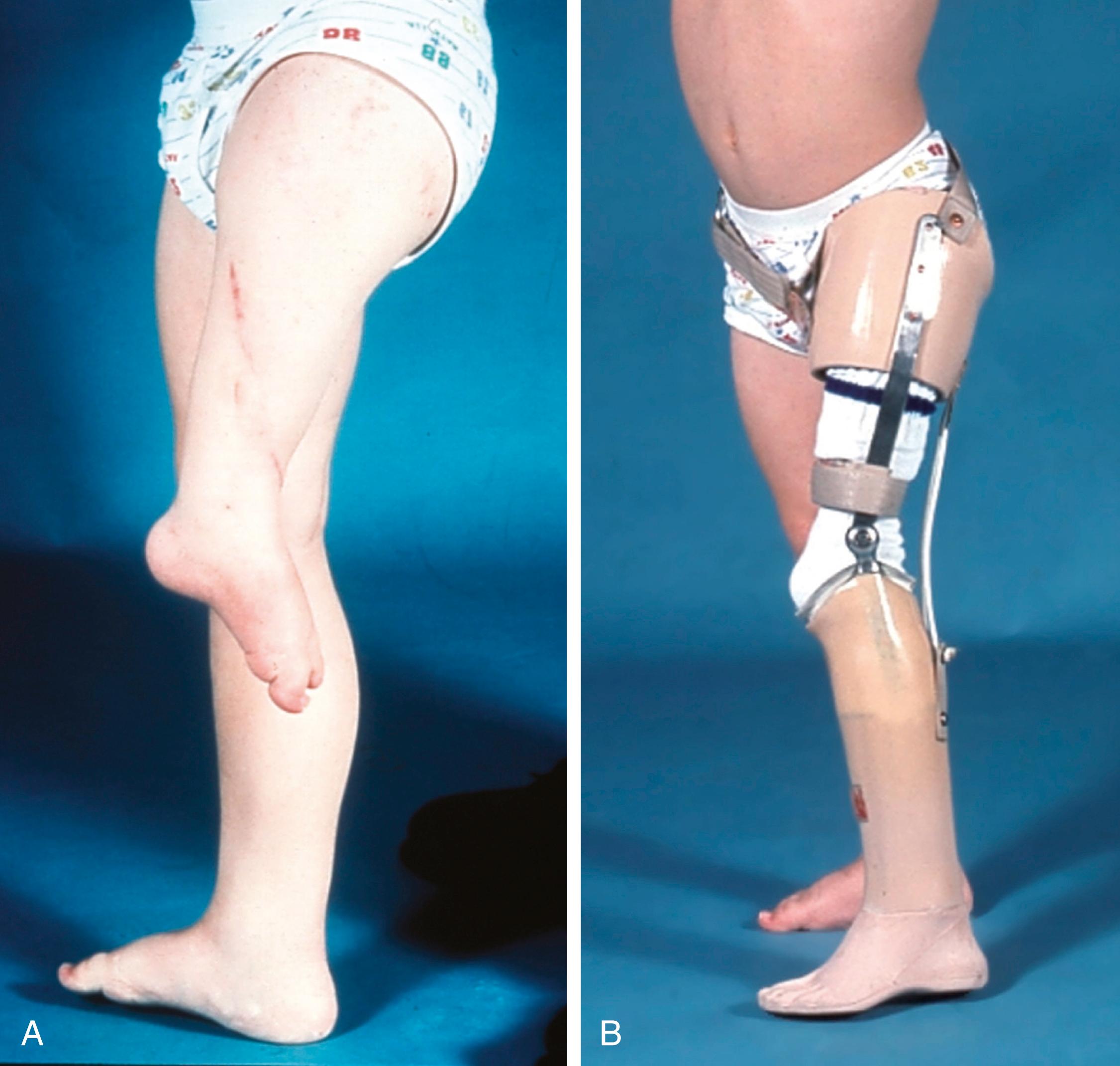 Fig. 21.21, (A) Proximal focal femoral deficiency, which was treated with a van Nes rotationplasty. (B) The ankle provides motor and sensory control of the prosthetic knee.