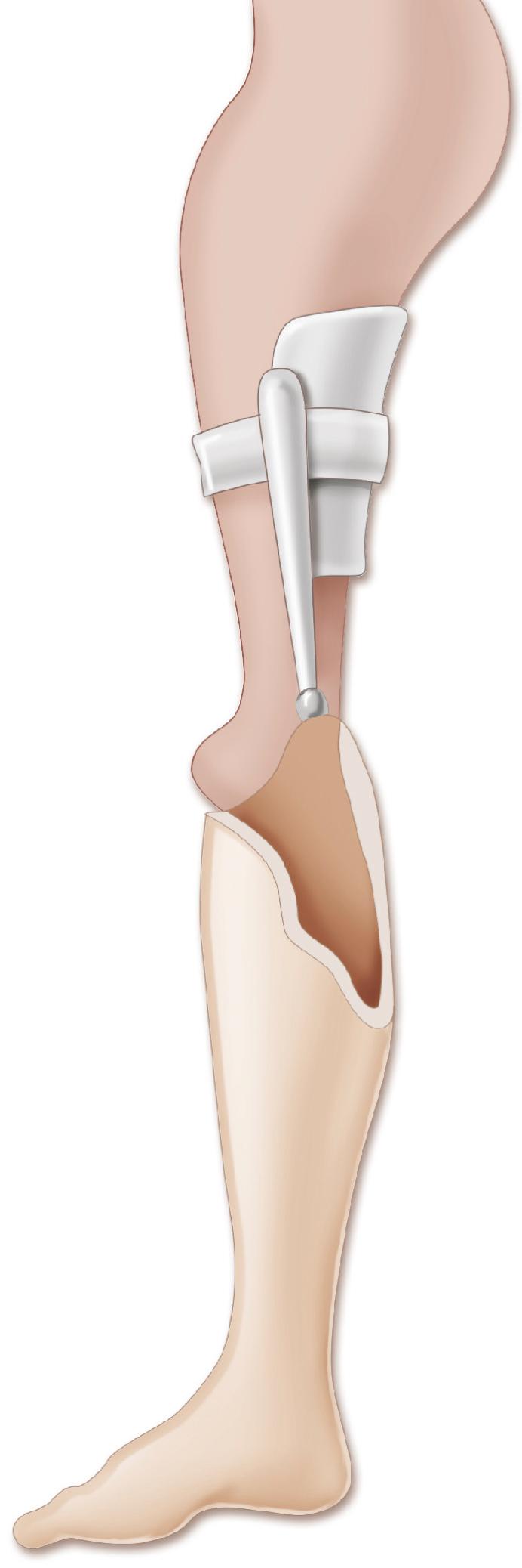 Fig. 21.22, Rotationplasty for proximal focal femoral deficiency. The ankle and foot are turned 180 degrees to activate the knee of the prosthesis.