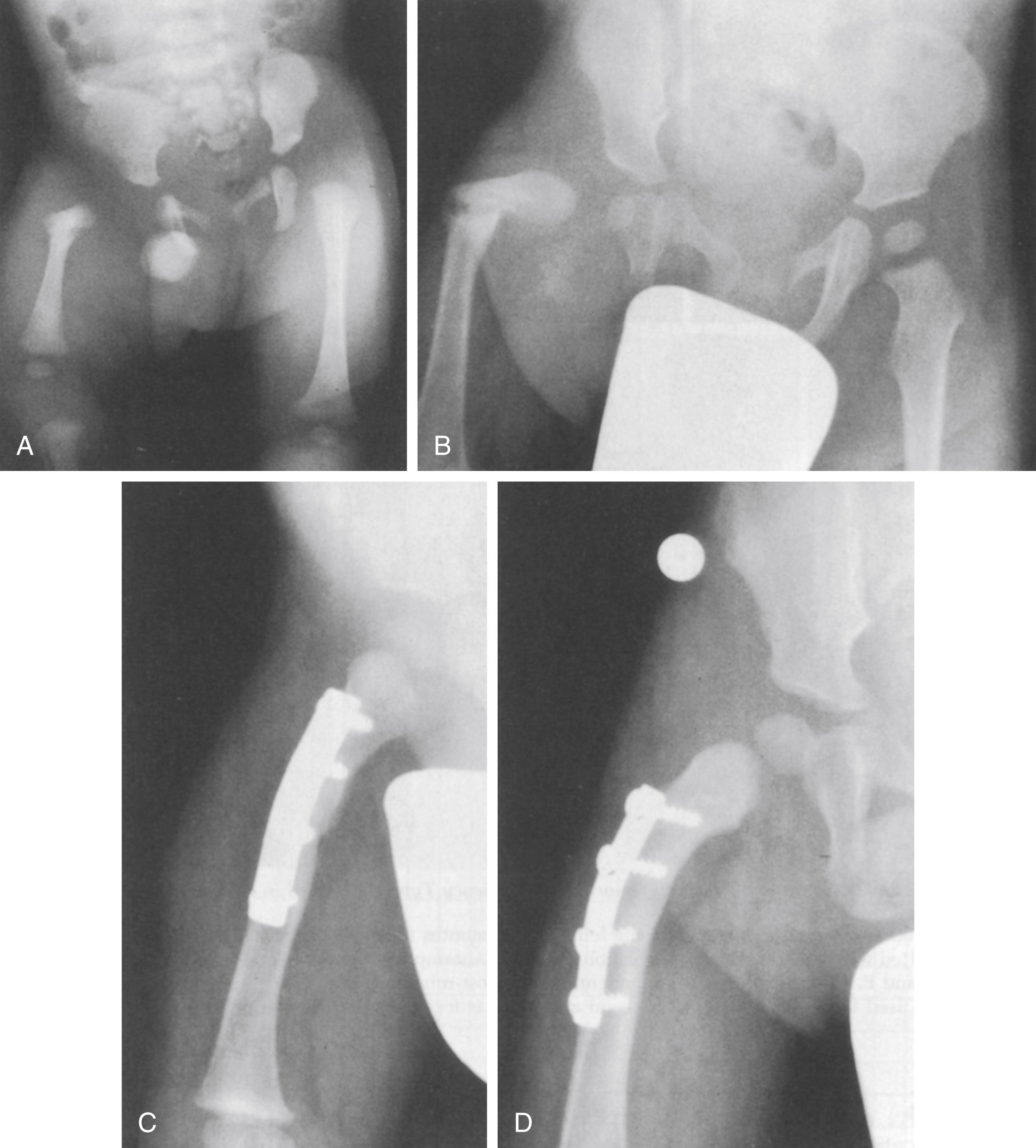 Fig. 21.23, An 18 month old girl with proximal focal femoral deficiency. (A) Anteroposterior (AP) radiograph at 18 months showing no ossification between the upper femoral shaft and the femoral head in the acetabulum. (B) AP radiograph at age 8 years showing further ossification of the upper femur with marked coxa vara. (C) AP radiograph at age 15 years following proximal femoral valgus osteotomy at age 8 years. (D) Clinical photograph at age 8 showing that her left knee is at the level of the right mid femur. (E and F) She became a vigorous athlete and was a varsity cheerleader at a major university.