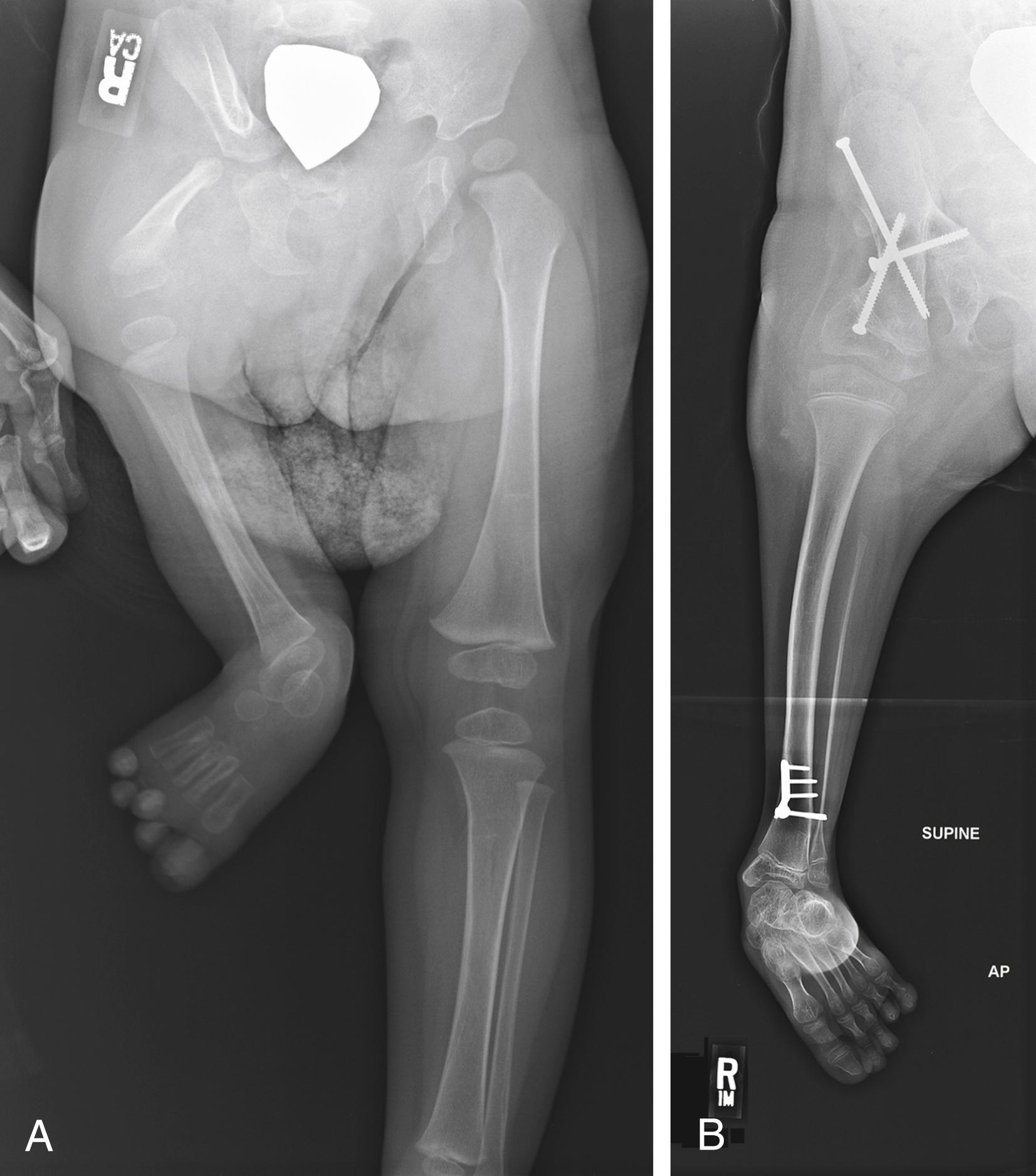Fig. 21.24, (A) 16-month-old girl with a right proximal femoral deficiency. There is no ossification of the femoral head and the acetabulum is poorly formed. Magnetic resonance images did not show a femoral head. (B) A radiograph of the right lower extremity after rotation and fusion of the femur to the pelvis. Additional rotation was done at the distal tibia.