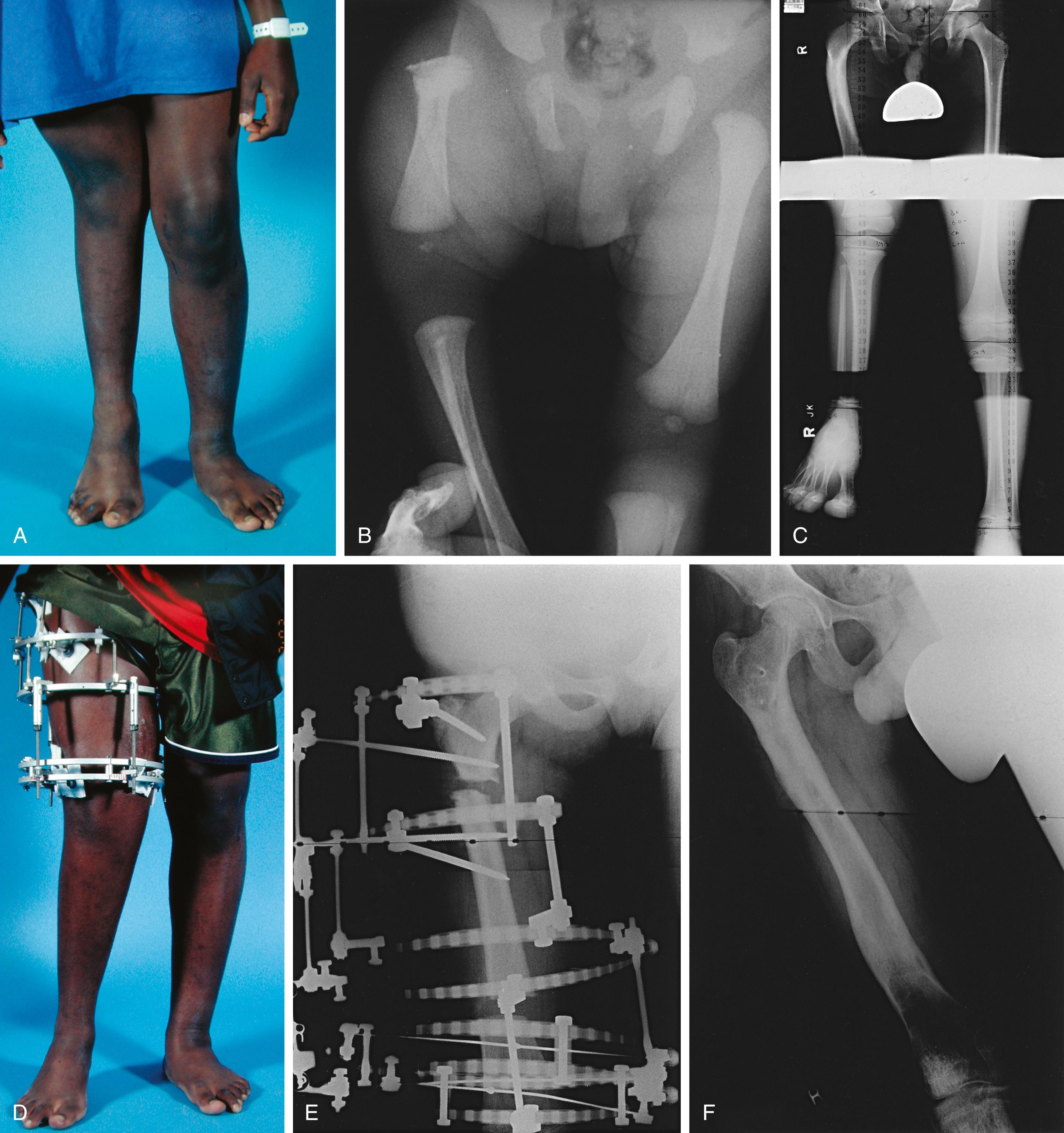 Fig. 21.25, Child with a Gillespie type A proximal femoral deficiency. (A) Front view showing a shortened right femur with lateral rotation of the femur and mild genu valgus. (B) Radiograph obtained at 1 month of age showing varus of the femoral neck, lateralization of the hip, and shortening of the femur. The femur is half as long as the contralateral femur. (C) Orthoroentgenogram obtained at 6 years of age showing a 12.5 cm limb length discrepancy. The hip appears reduced without treatment. (D) Patient at age 14 years with a circular fixator in place for femoral lengthening. (E) Radiograph showing placement of the circular fixator. (F) Radiograph obtained after femoral lengthening, in which the femur gained 9 cm. The patient also underwent a contralateral epiphysiodesis.