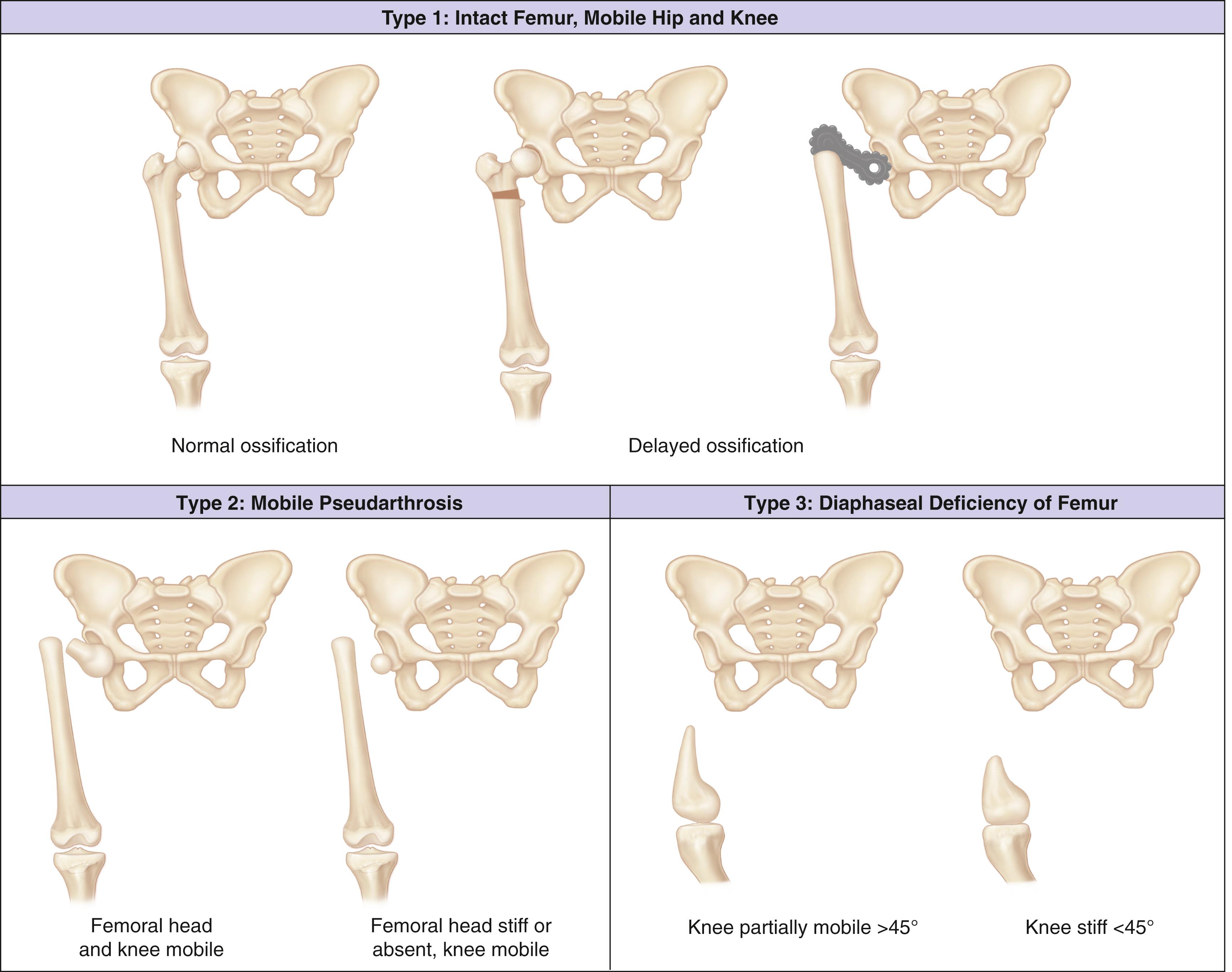 Fig. 21.26, Paley classification of congenital short femur syndrome types 1 to 3.
